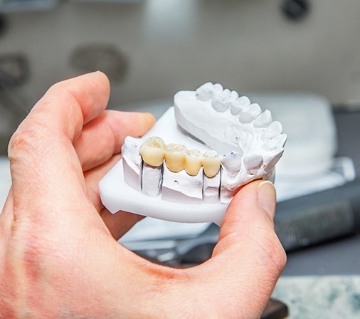 Digital illustration of a dental bridge